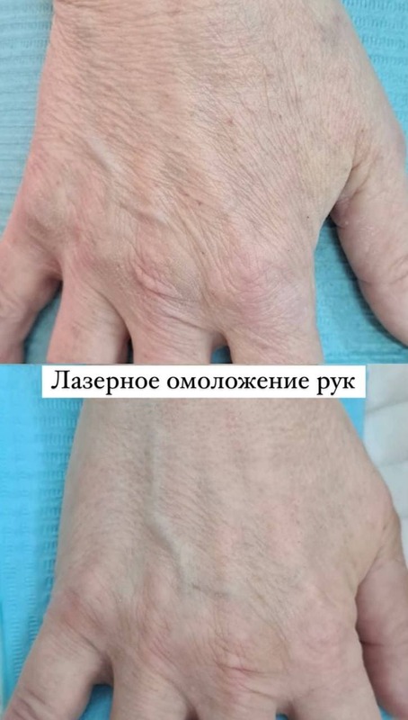 Лазерное омоложение лица фото 6